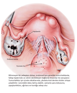 çikolata kisti nedir?
