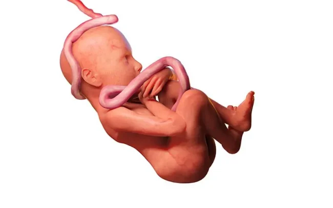 bebeğin boynuna kordon dolanması